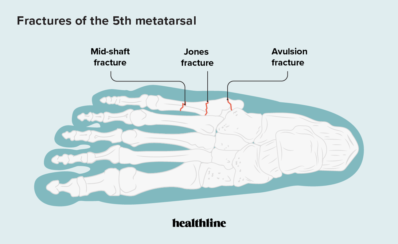 Трещина 5 букв. Перелом пятой плюсневой кости. Деформация основания 5 плюсневой кости стопы.