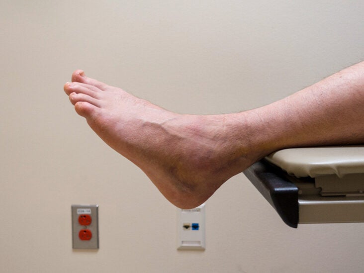 Broken ankle - Symptoms & causes - Mayo Clinic