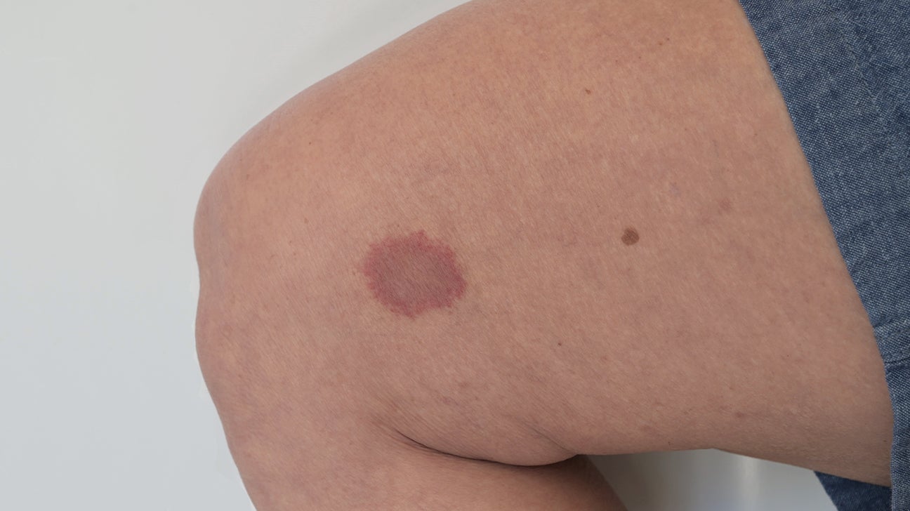 Bites and Stings Pictures, Causes, and Symptoms