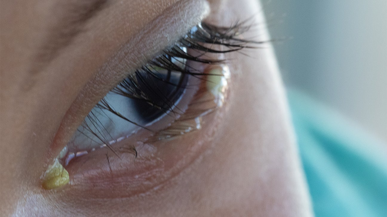 What Causes Crusty Dry Eye Discharge?