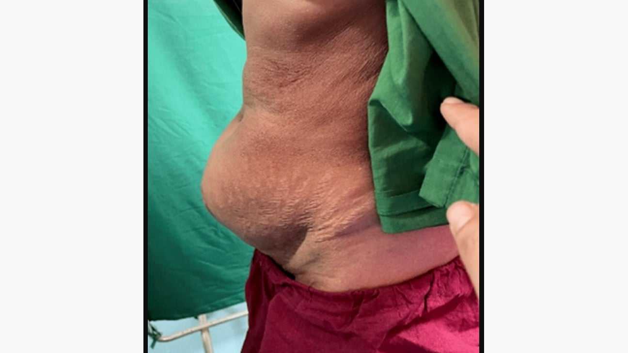 https://post.healthline.com/wp-content/uploads/2022/10/incisional-hernia-cesarean-c-section-body1-1.jpg