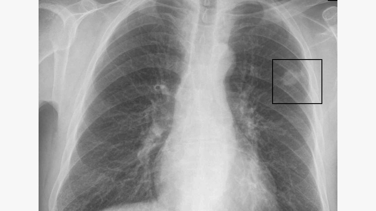 Lung Nodule Size Chart What The Size Of Nodules Indicates