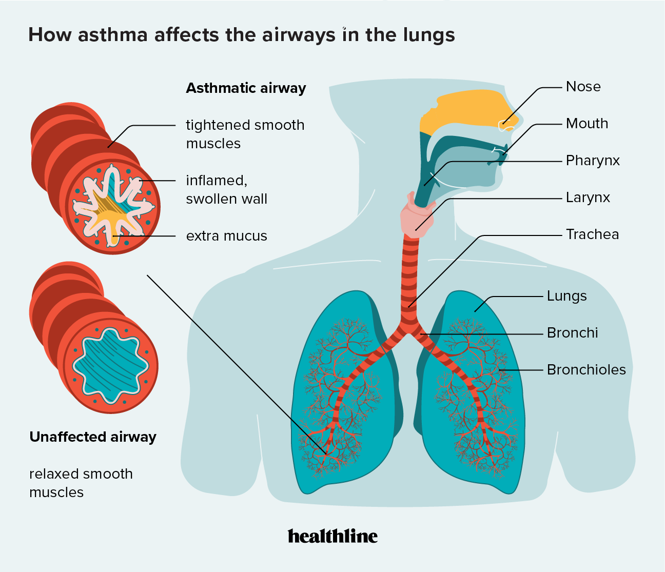 Asthma and difficulty breathing: resources for teenagers and young adults