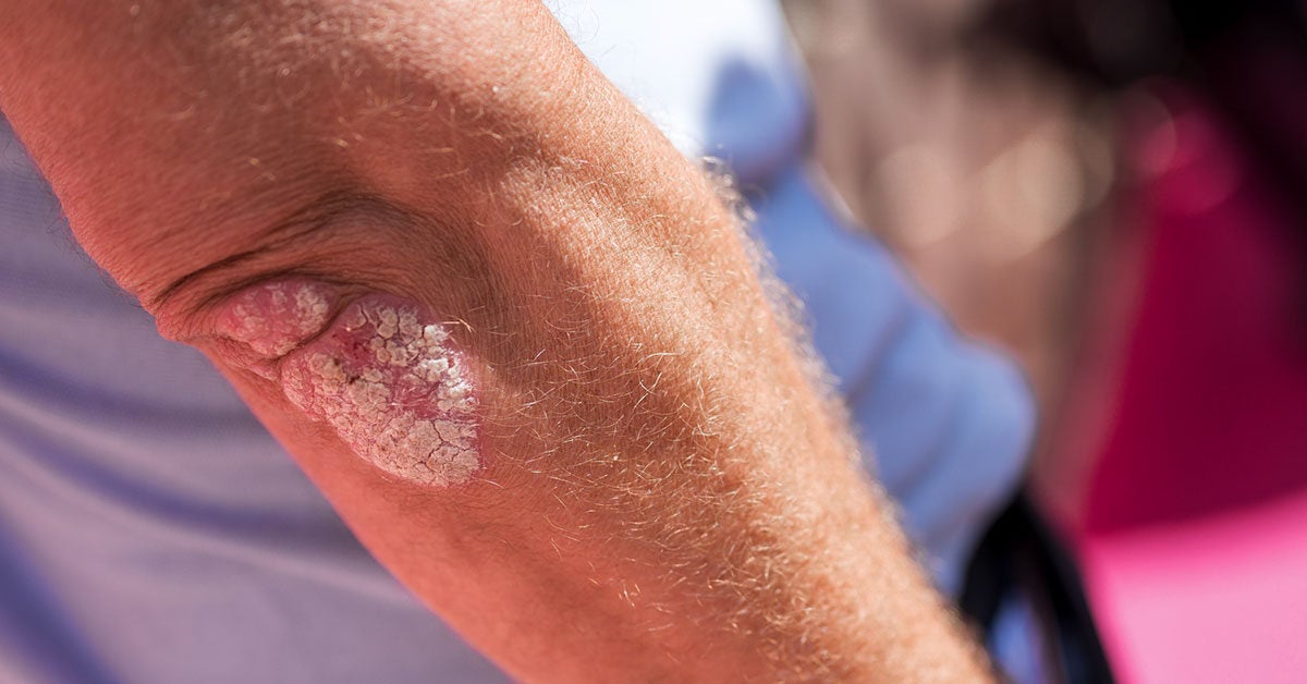 Psoriasis Elbow