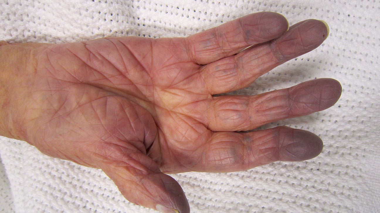 sofa forstyrrelse podning Peripheral Cyanosis (Blue Hands and Feet): Causes and More