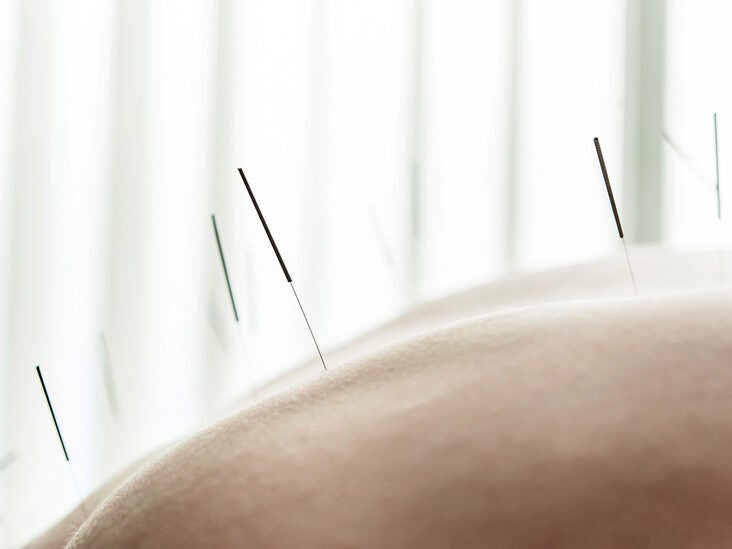 Acupuncture During Pregnancy May Help Relieve Low Back and Pelvic Pain