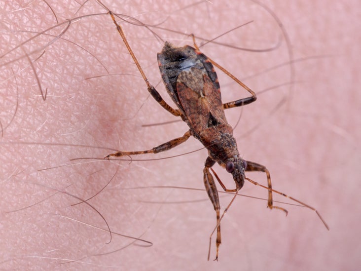 chagas-disease-signs-and-symptoms-and-treatments