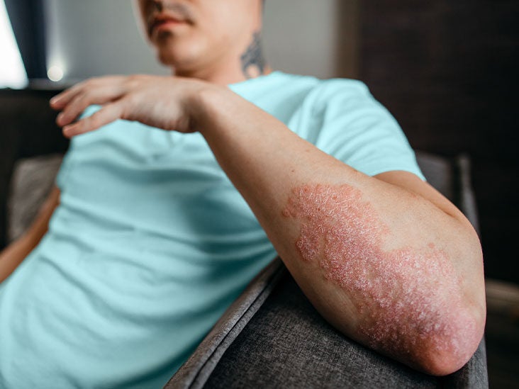 How Psoriasis Can Affect the Digestive System