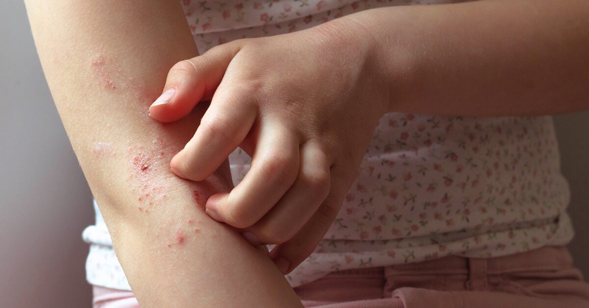Betamethasone for Eczema Use, Complications, Outlook