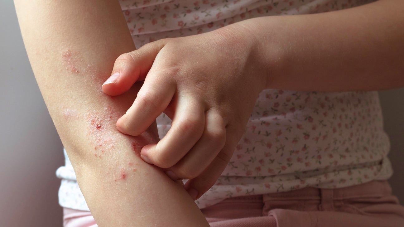 Can Pinworms Cause Eczema?