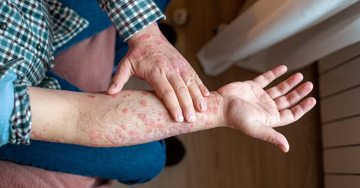 Psoriasis and Rheumatoid Arthritis: Are They Connected?