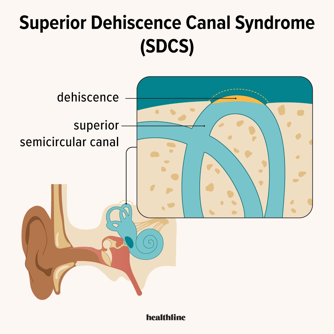 Superior Dehiscence Canal Syndrome: Symptoms, Causes, and Treatment