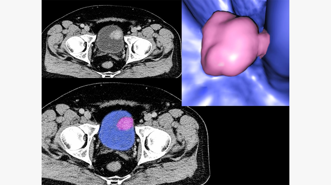 How Accurate Is a CT Scan Cancer? & More
