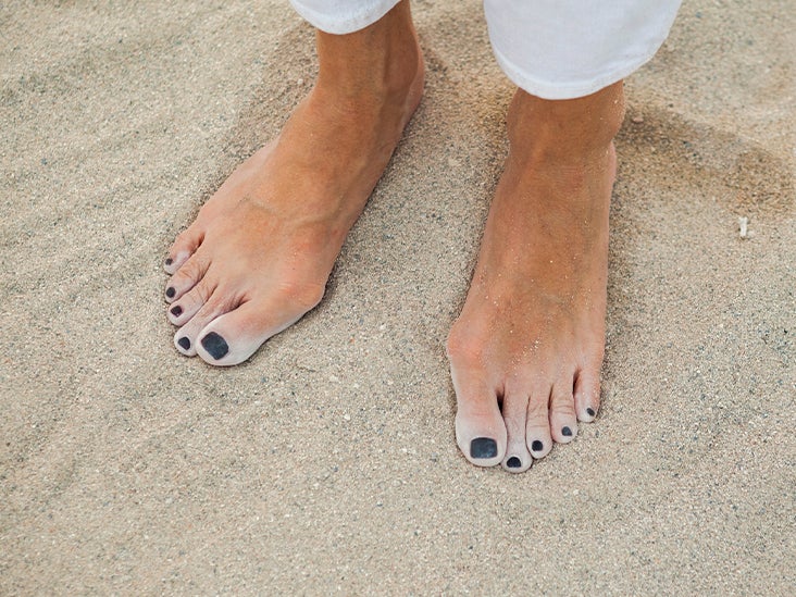 Bunion Correction Which Options Work and Which Don’t?