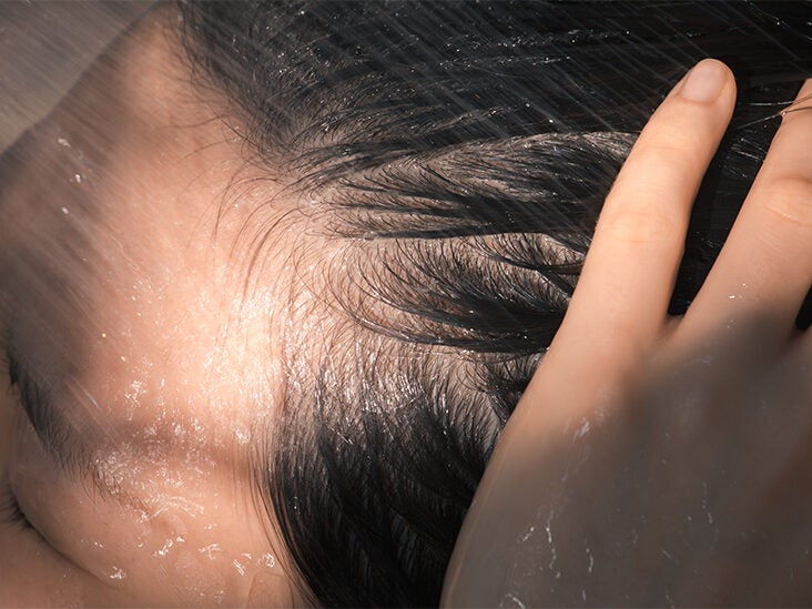 Bugs on Your Scalp That Aren't Lice: Types and How to Treat Them