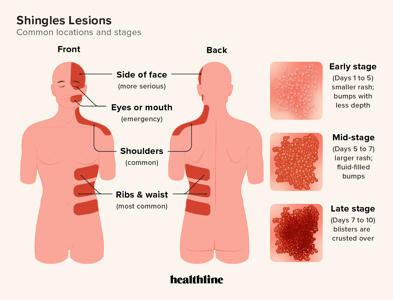 Shingles Lesions Pictures Location Duration And Treatment 