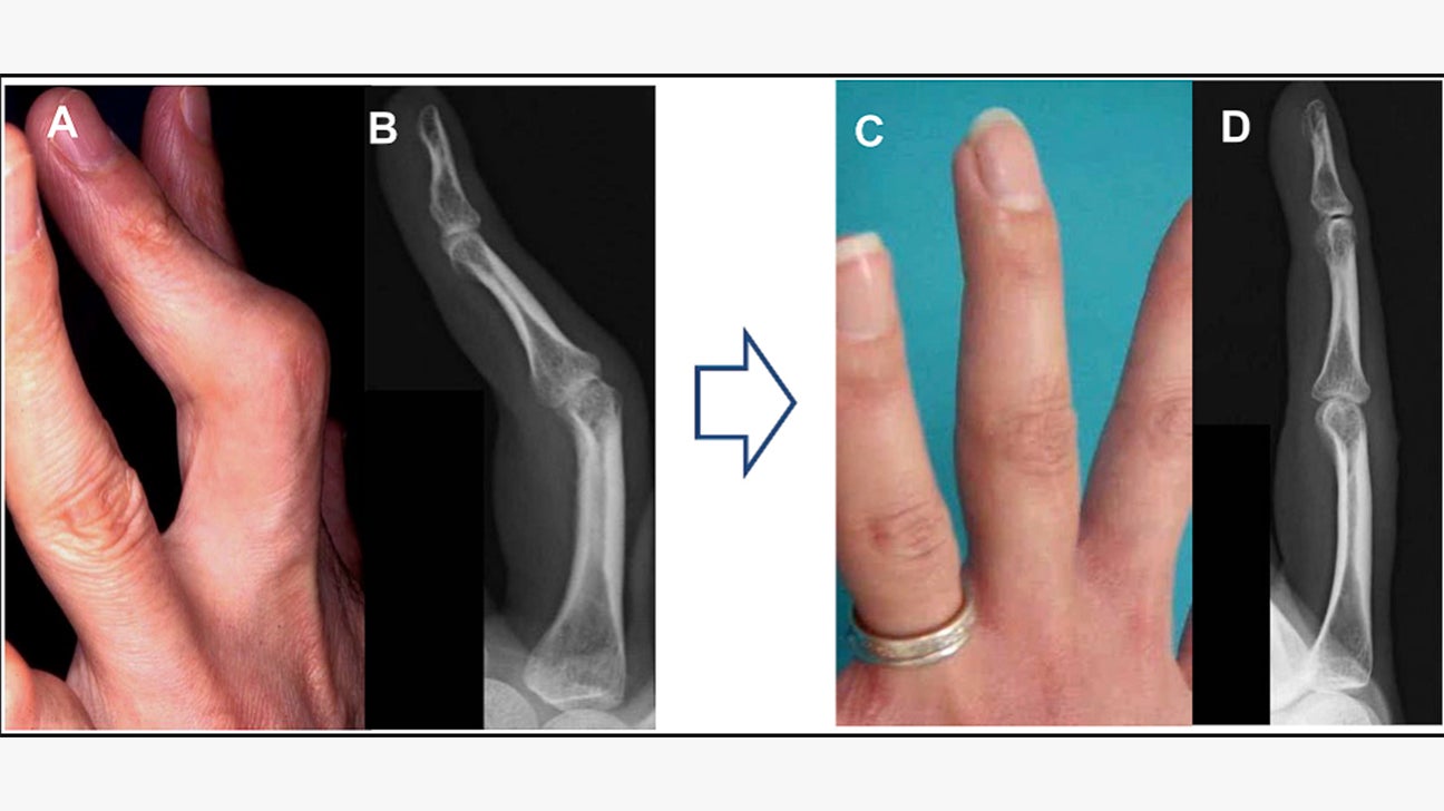 Before And After Rheumatoid Arthritis Surgery On Hands, Feet