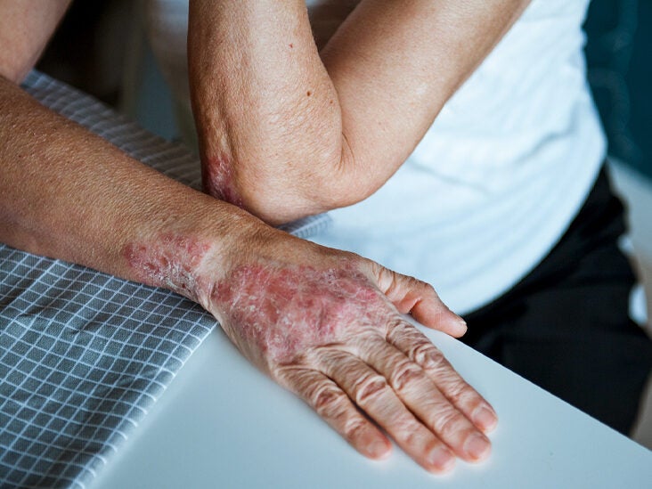 How to Treat Cracks and Bleeding from Psoriasis on the Hands