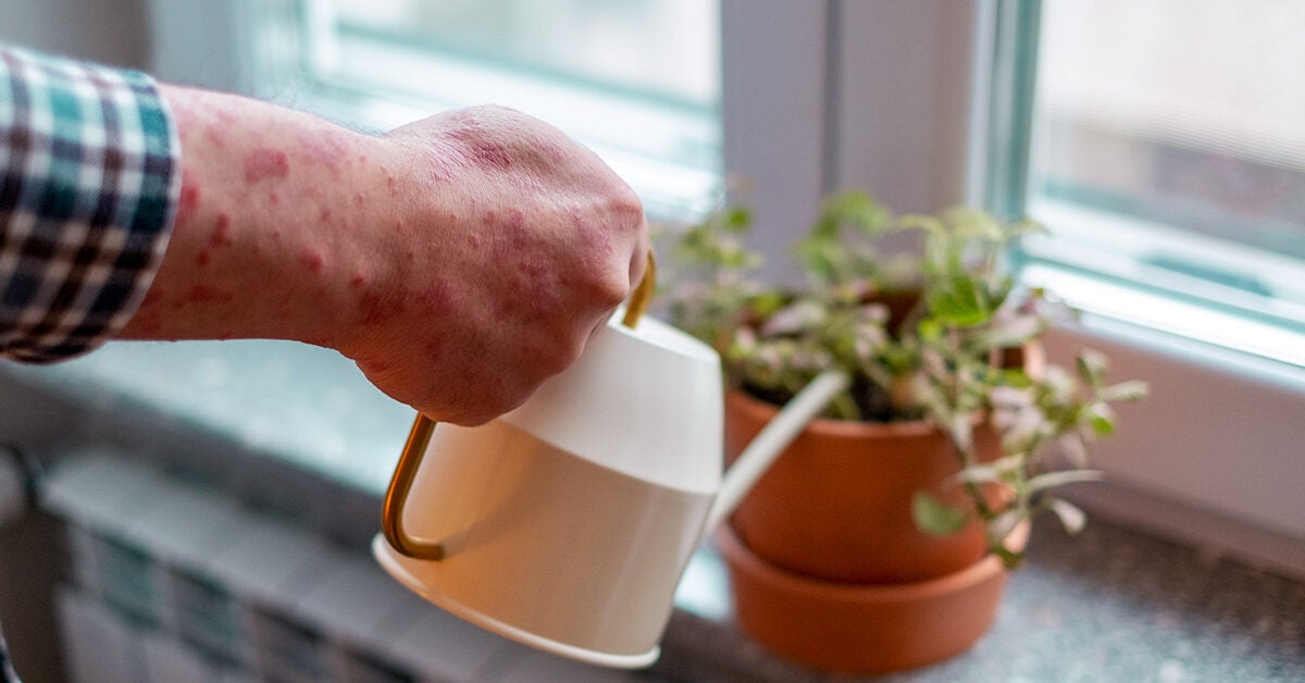 7 Natural Ingredients for Psoriasis