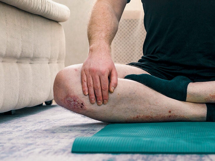 Can You Get Psoriasis on Your Knees?