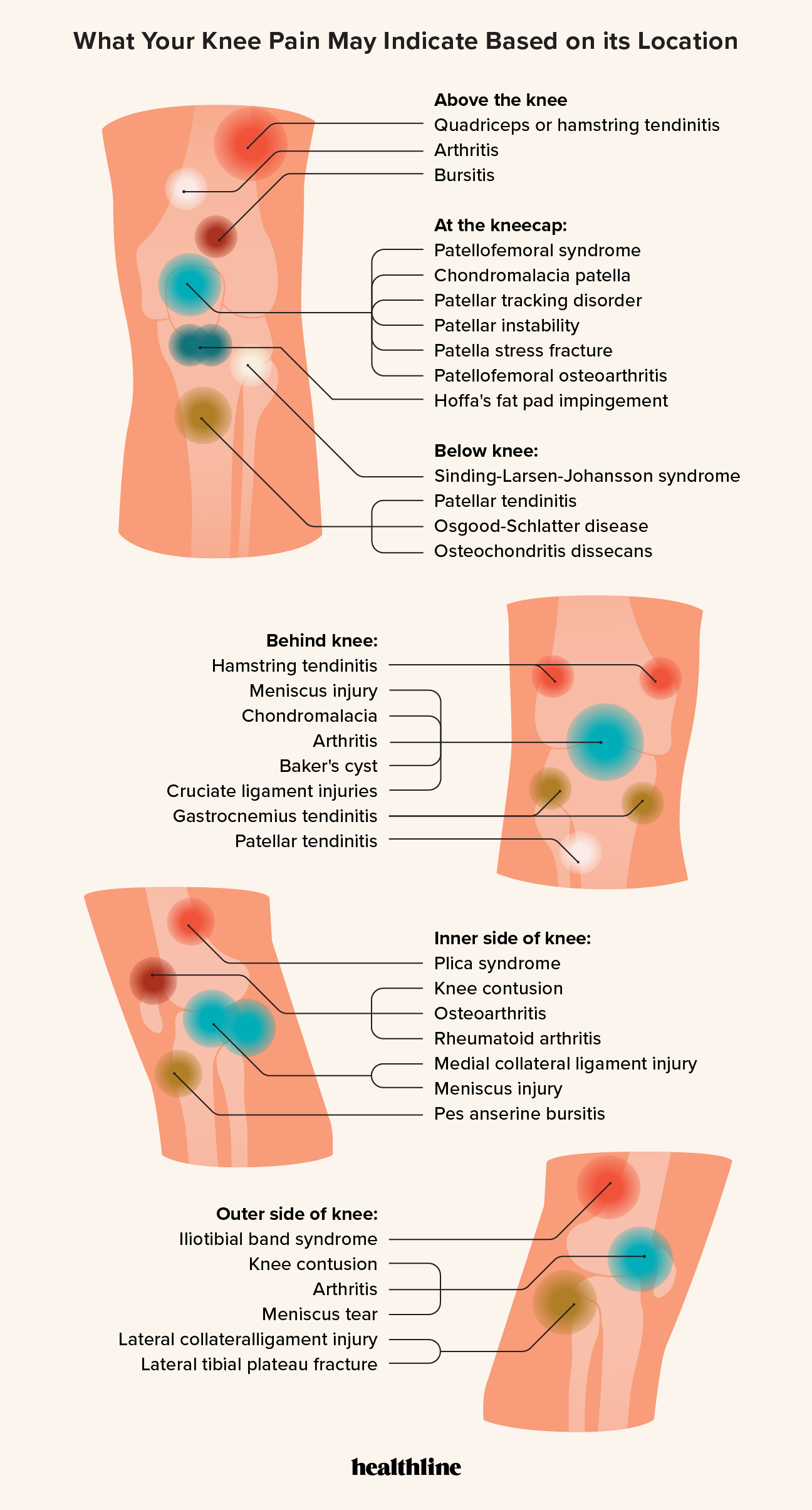 Knee Pain Location Chart: What Knee Pain May Indicate
