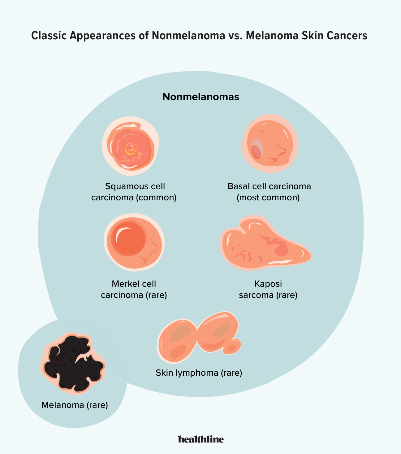 Nonmelanoma Skin Cancer: Types, Treatment, and Outlook