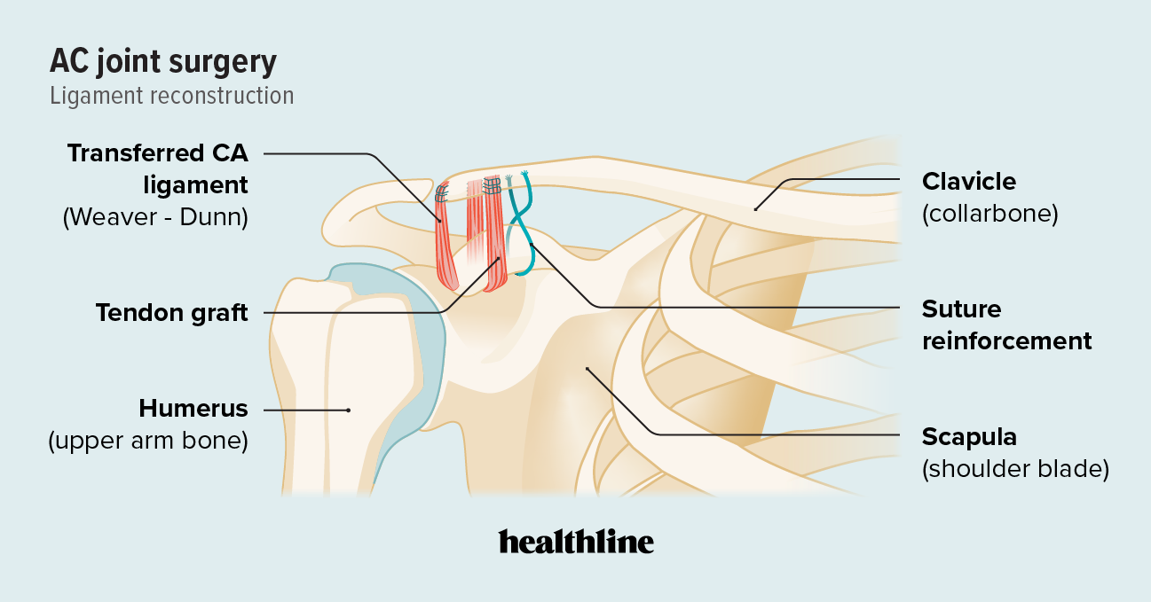 Ac Joint Anatomy AC Joint Dislocation Treatment Your Shoulder