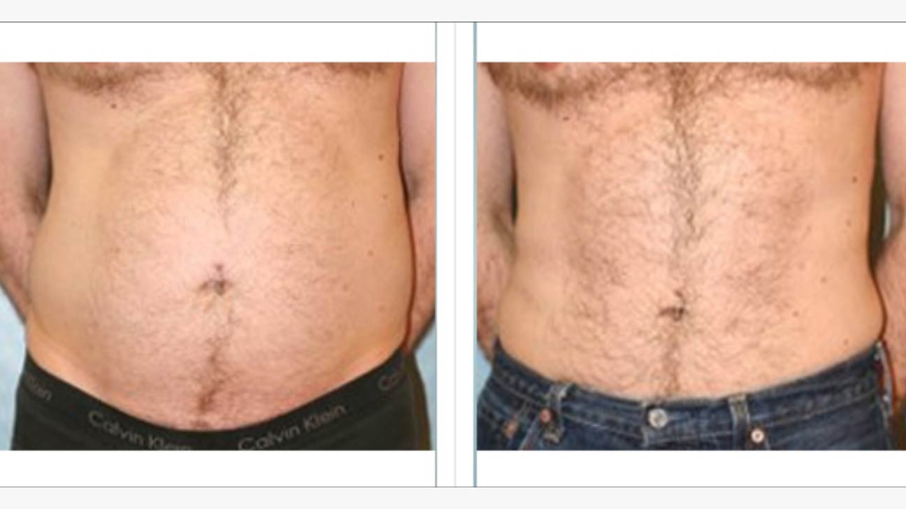 Liposuction Austin Tx