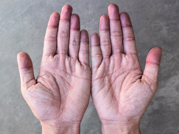 Peripheral Cyanosis (Blue Hands and Feet): Causes and More
