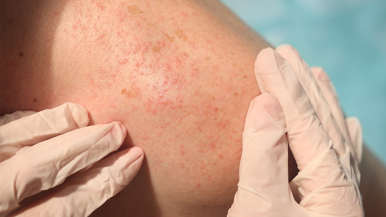 Is your skin rash an STD rash?. Any change in the genital area