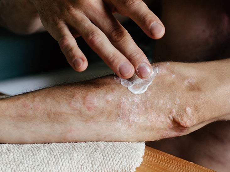 What Are Related Medical Conditions of Psoriasis? Your FAQs