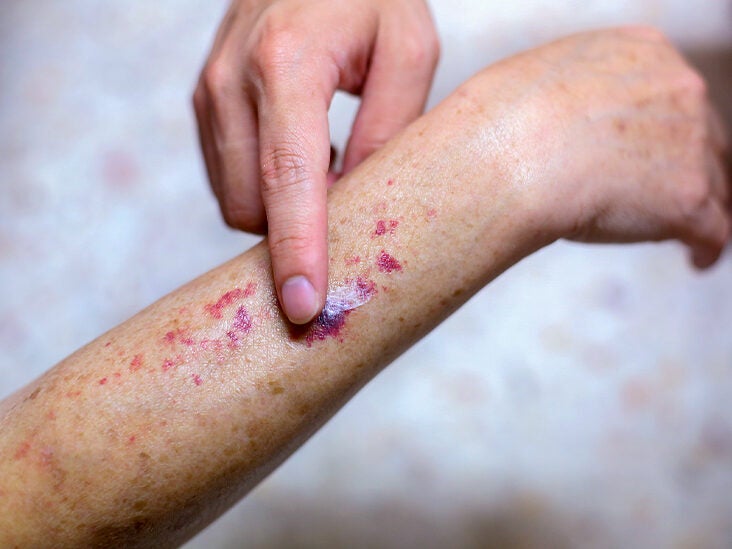 Rash: 22 Common Skin Pictures, Causes
