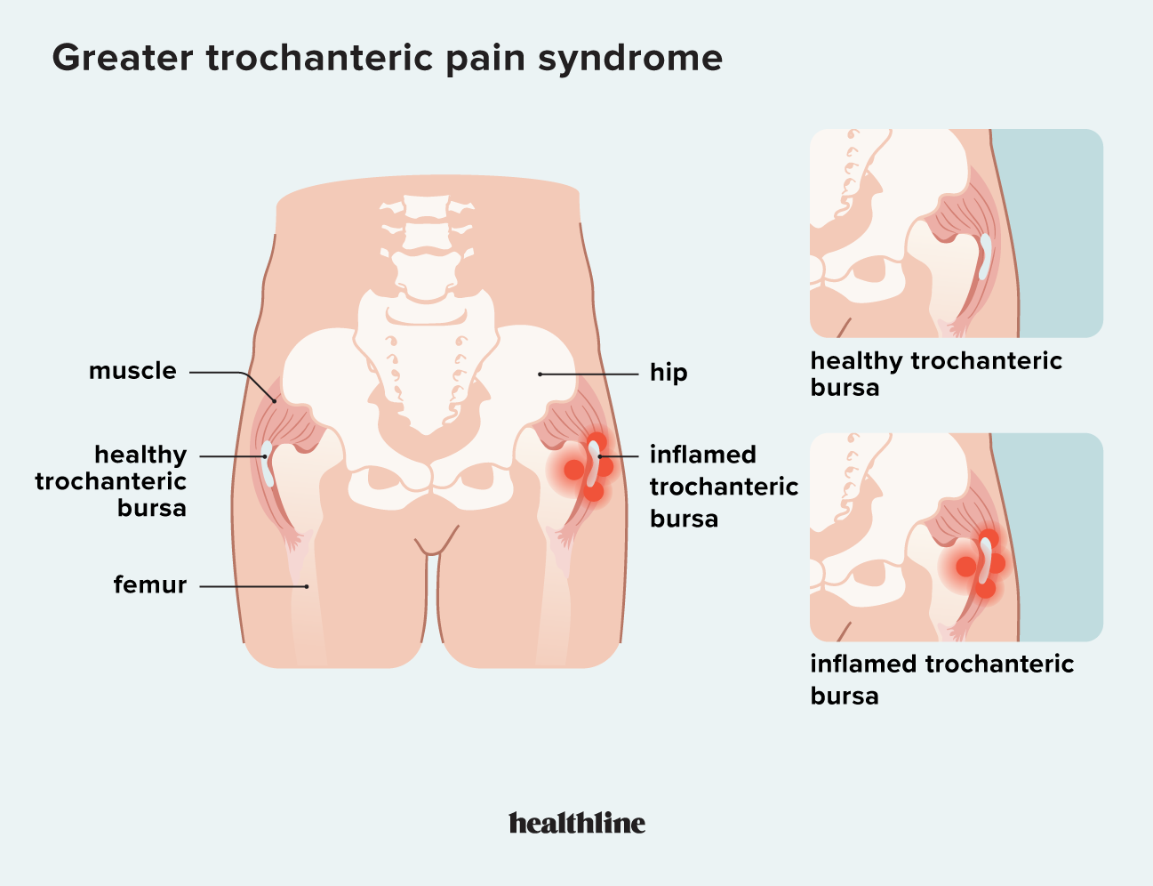 https://post.healthline.com/wp-content/uploads/2023/03/2729063-Treating-Greater-Trochanteric-Pain-Syndrome-1296x728-header-body-1.png