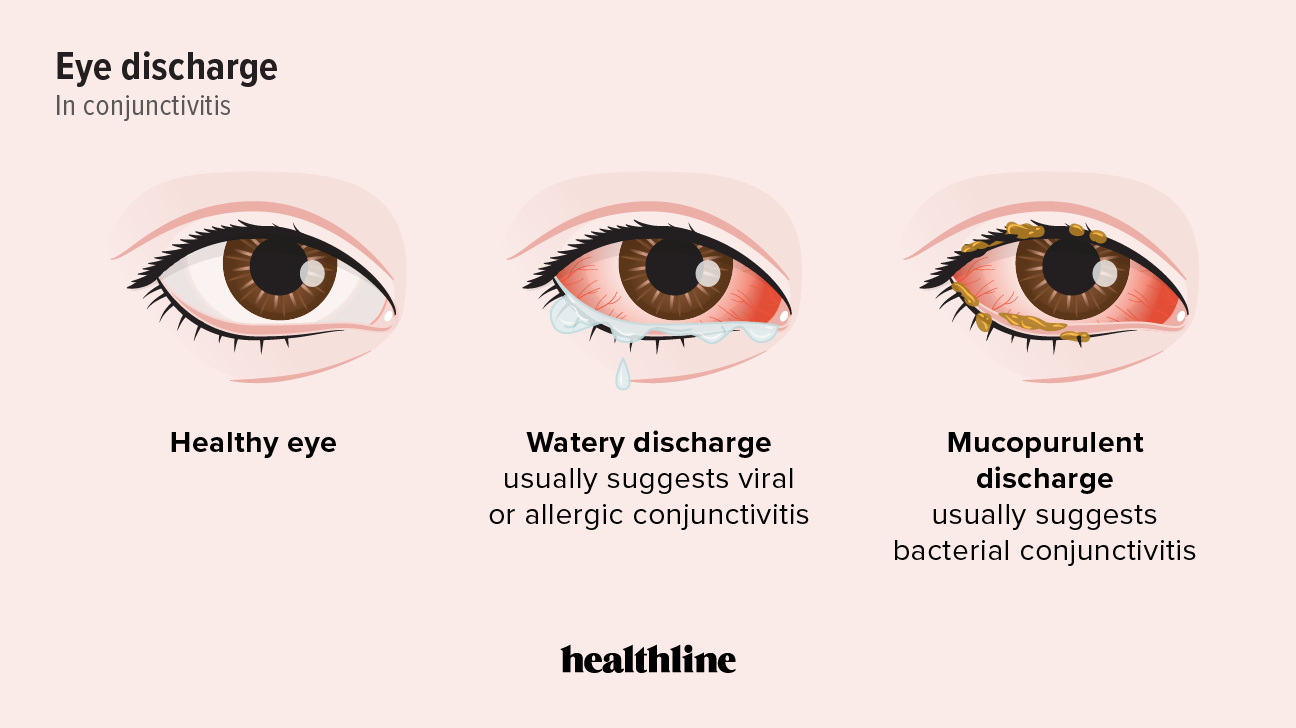 Causes Of Watery Discharge From Eyes And Nose Infoupdate