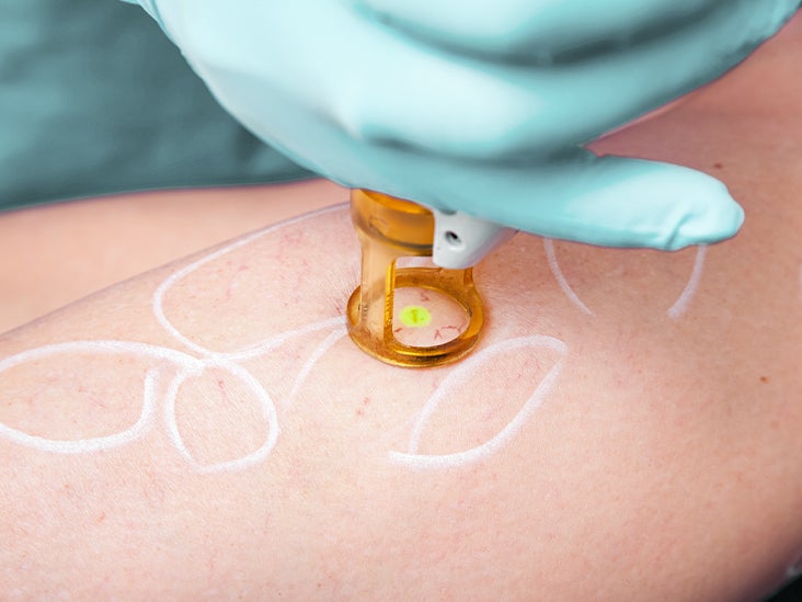 Spider Vein Removal Cost Average Cost, Insurance Coverage, and More