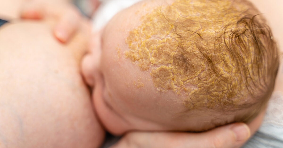 cradle-cap-vs-eczema-seborrheic-and-atopic-dermatitis