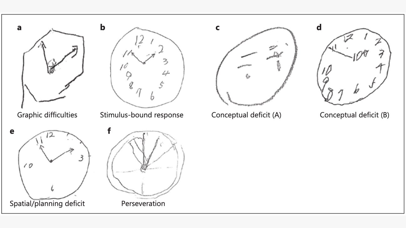 How Is the Clock Drawing Test (CDT) Used with Schizophrenia?