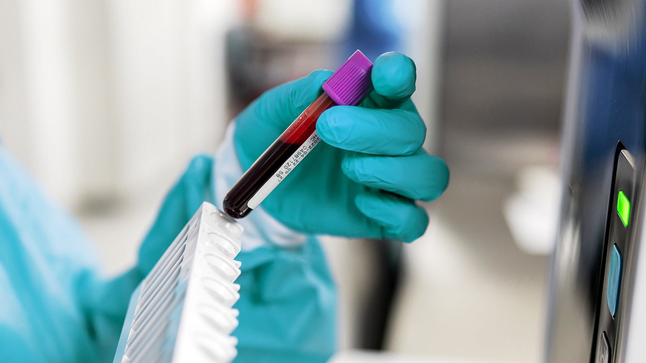 Study Examines Whether Blood Test Can Identify Early Cancers - NCI