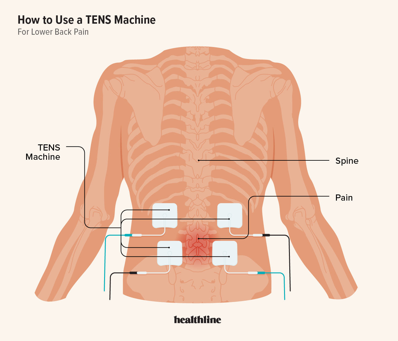 https://post.healthline.com/wp-content/uploads/2023/04/2853420-How-to-Use-a-TENS-Machine-for-Lower-Back-Pain_1296x1010-body.png