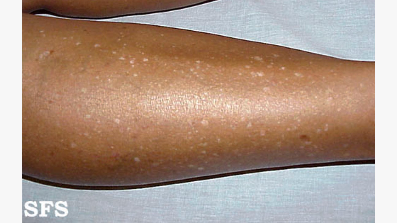 White Spots On The Skin Possible Causes And Treatments