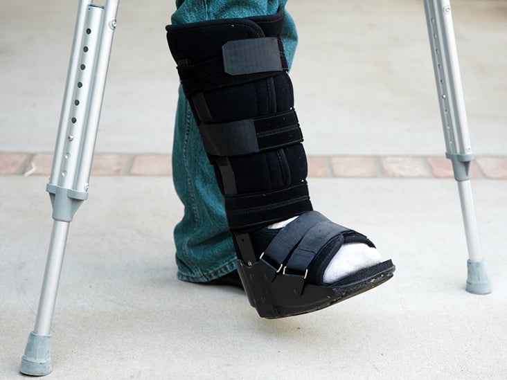 What To Know About Ankle Replacement Surgery