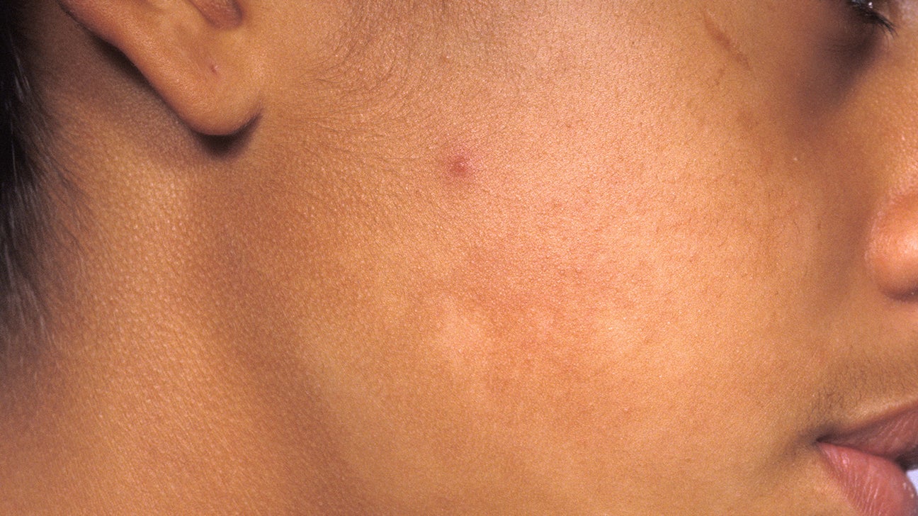 White Spots On The Skin Possible Causes And Treatments White Spots On The Skin Possible Causes And Treatments