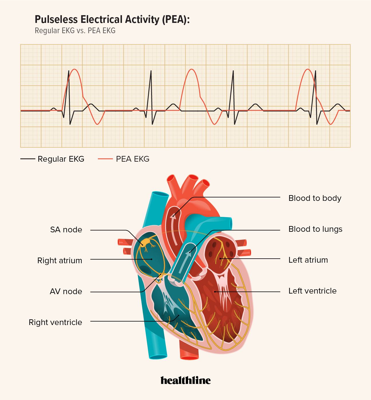 Pulseless Electrical Activity PEA Causes Diagnosis Treatment Pulseless Electrical Activity PEA Causes Diagnosis Treatment