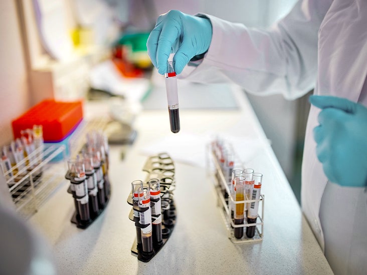 Lymphocytosis with Smudge Cells: Definition and Causes