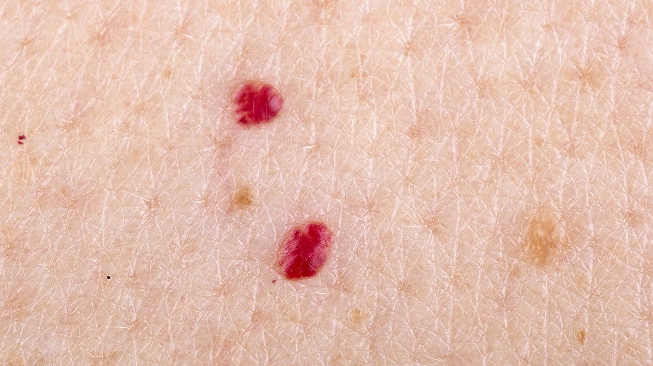 Cherry Colored Dots On Skin