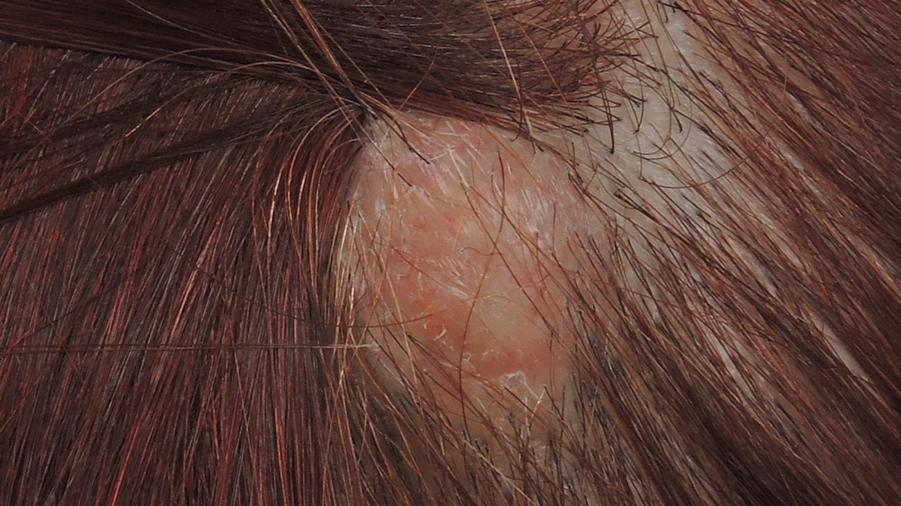 What Is Ingrown Hair Symptoms  Treatments