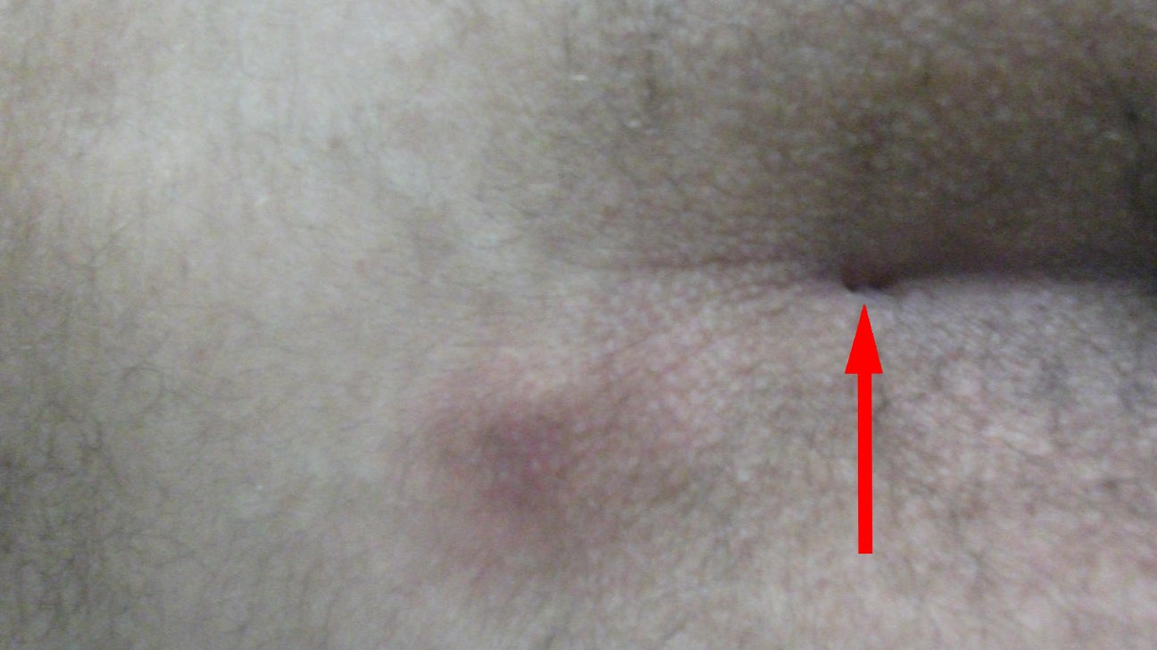 Ingrown hair on penile shaft What it looks like and how to remove