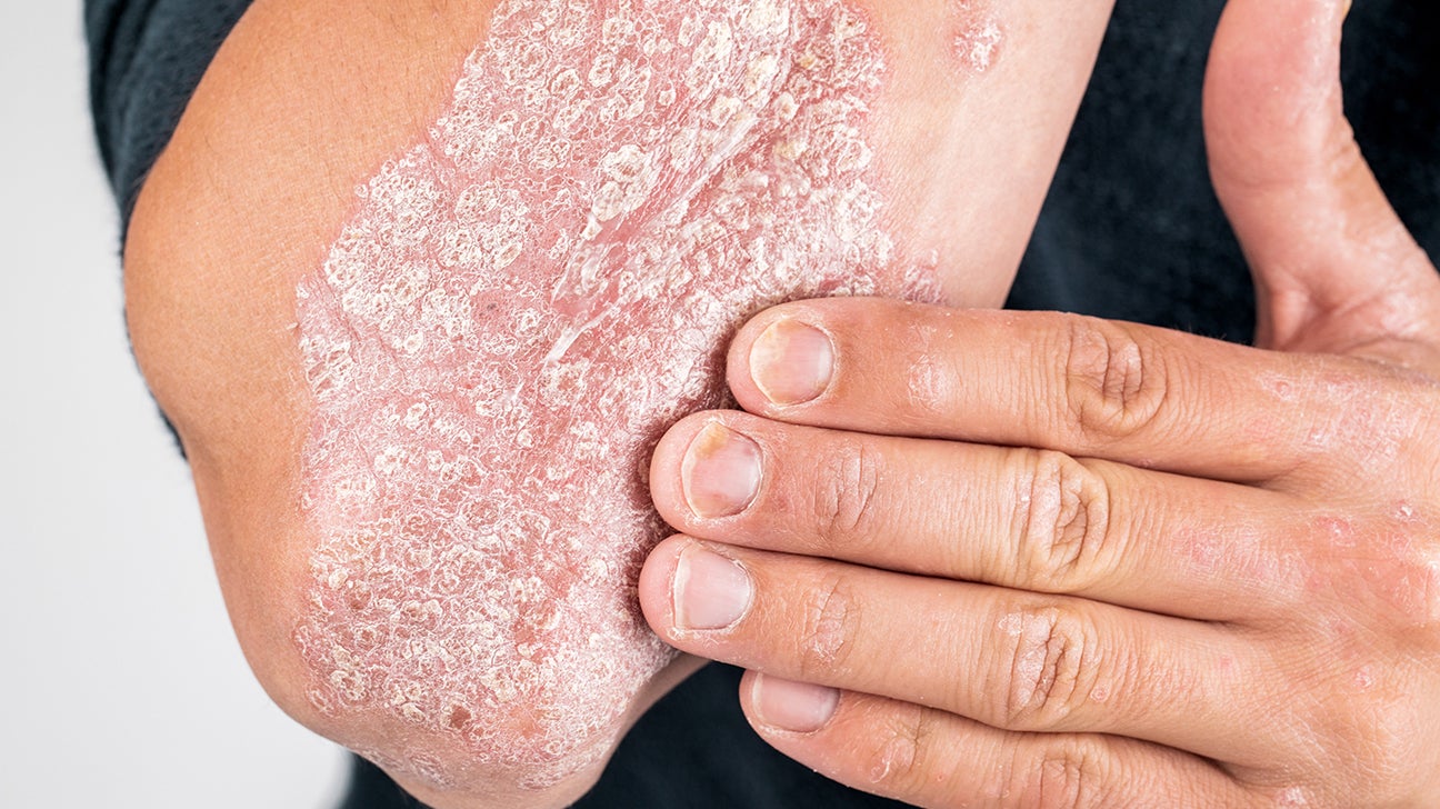 Locations and Types of Psoriasis What to Know