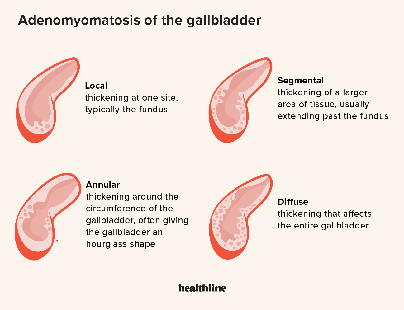 Adenomyomatosis of the Gallbladder: Symptoms, Causes, Treatment, More