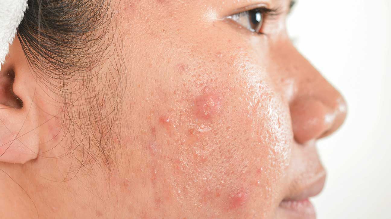 kubiske Ferie intelligens Types of Acne Scars: Pictures of Boxcar, Icepick, Rolling, and More